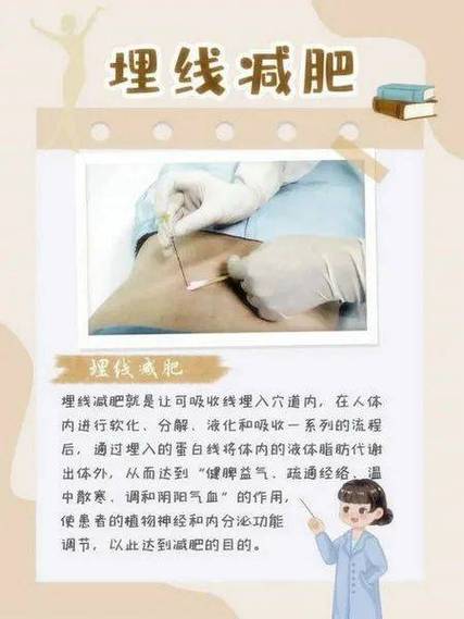 杭州埋线减肥挂什么科