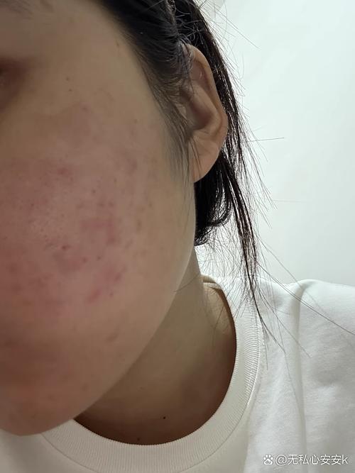 用洗面奶洗脸脸上长痘