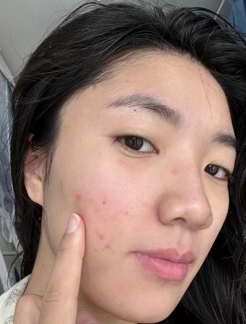 用洗面奶洗脸脸上长痘