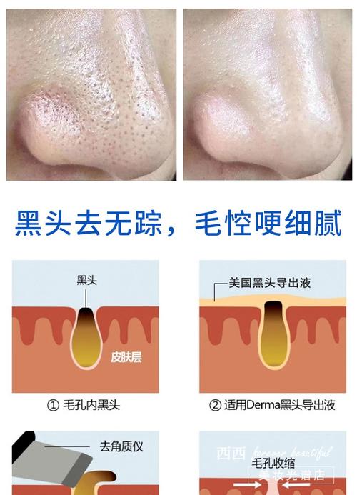 收缩毛孔黑头的护肤品