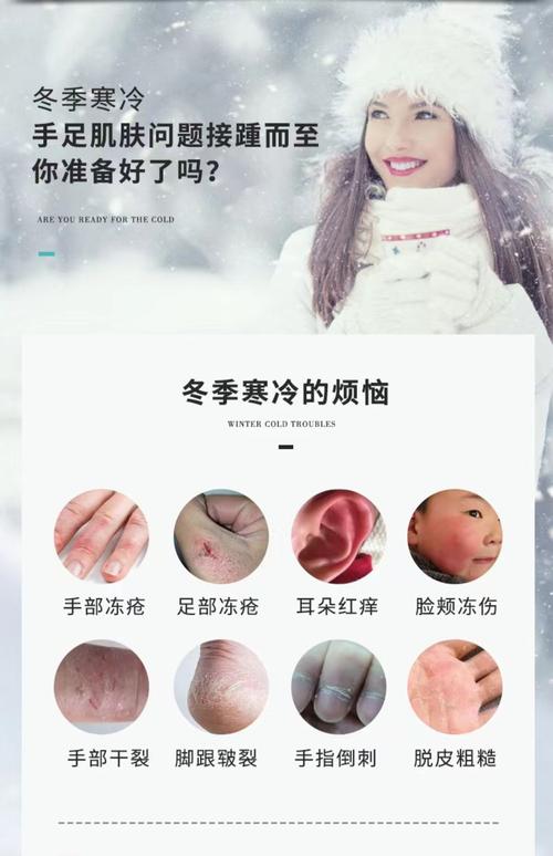 什么能治冻疮