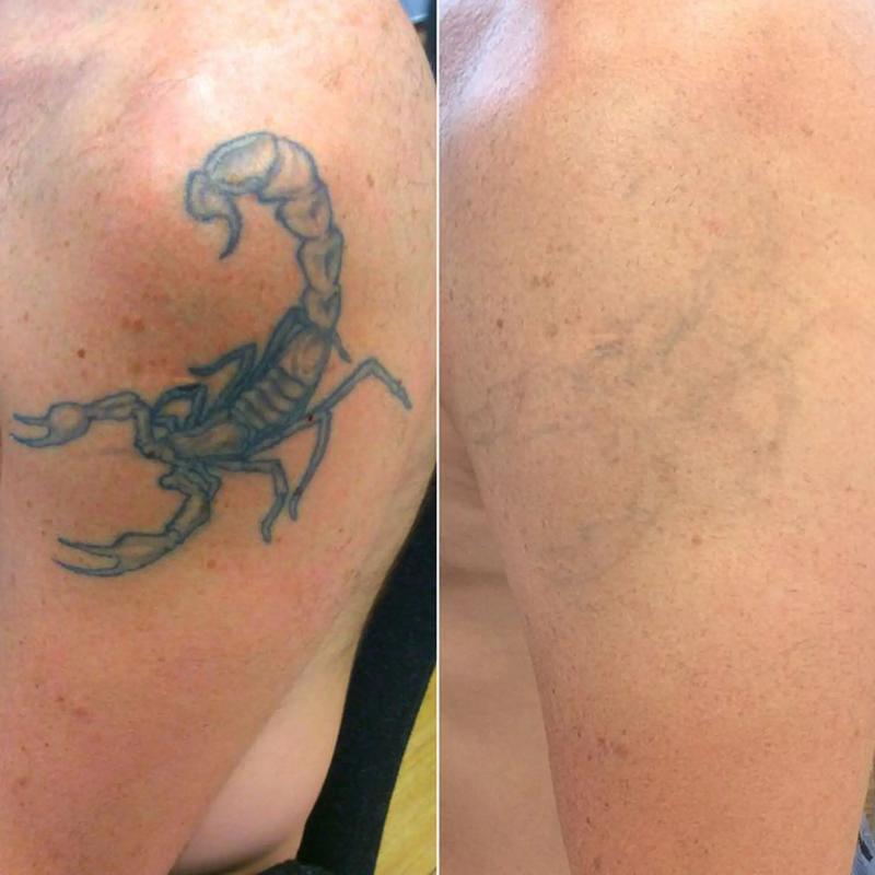 为什么纹身洗不掉