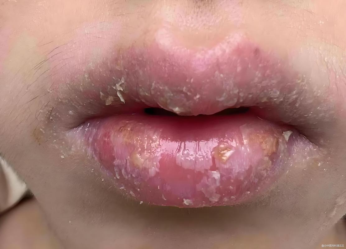 嘴唇为什么会脱皮