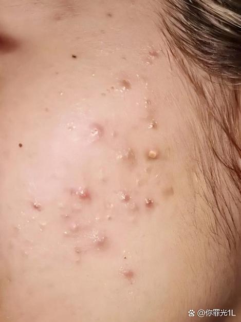 韩律艾草洗面奶起疙瘩