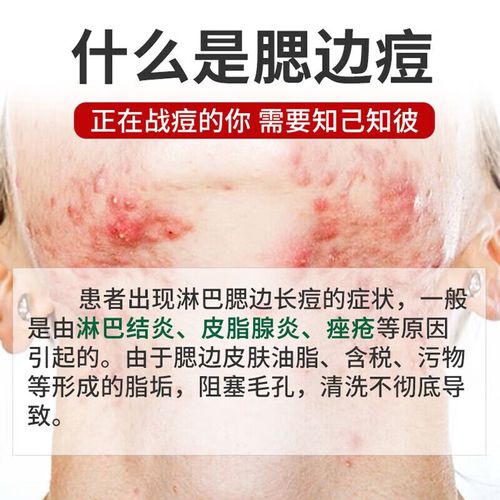 下巴长痘吃什么好