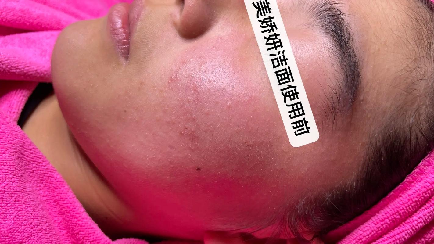 用了百雀羚洗面奶过敏