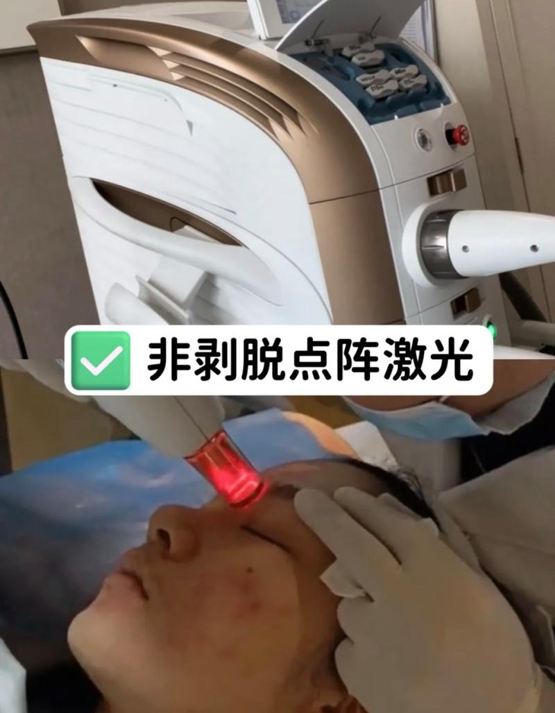 点阵激光是什么