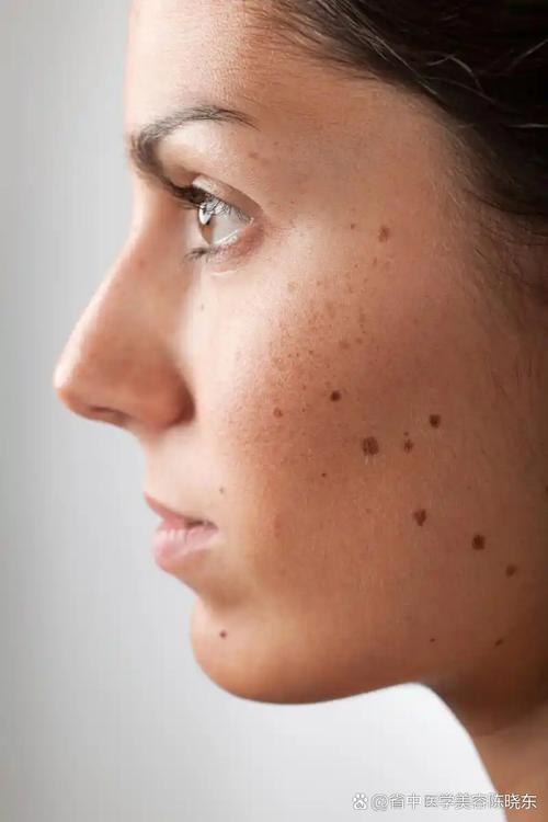 为什么脸上长黑斑