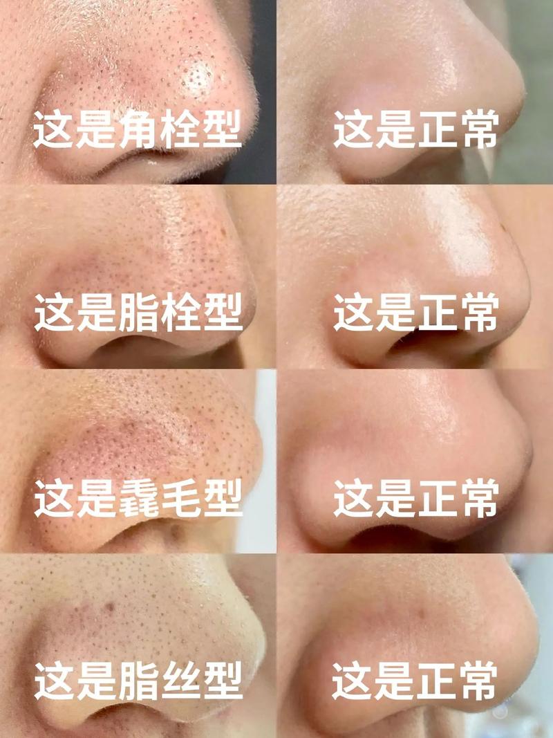 鼻子为什么有黑头