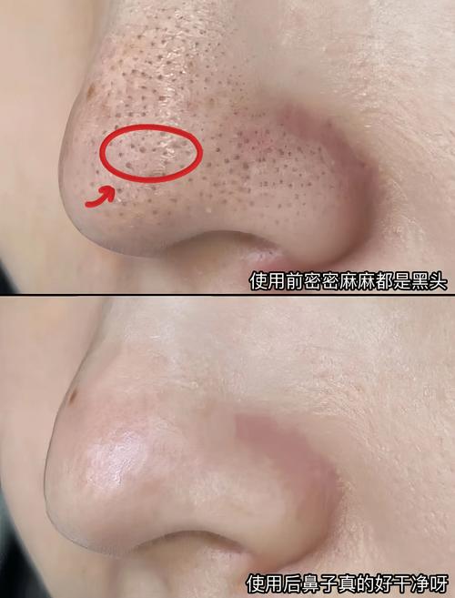 鼻子为什么有黑头