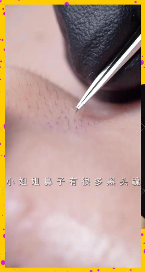 为什么鼻子有黑头