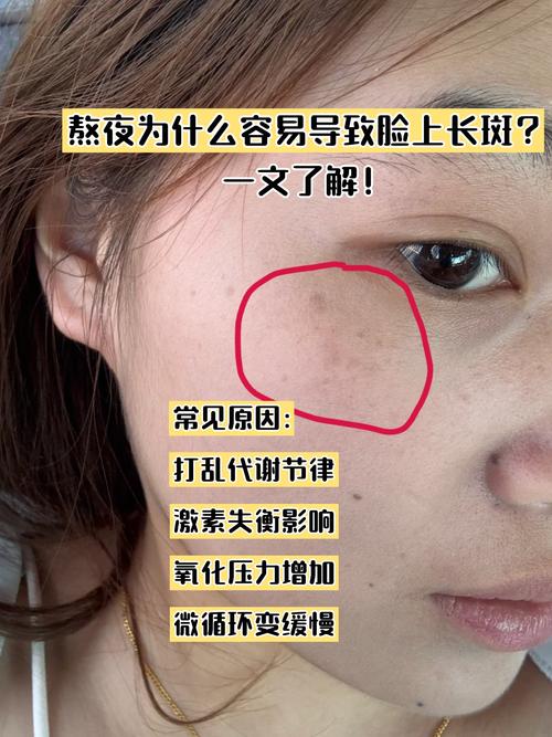 脸上为什么长黑斑