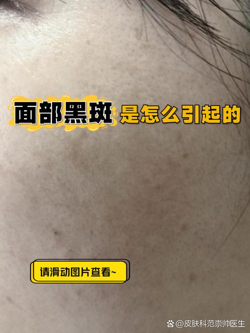 脸上为什么长黑斑