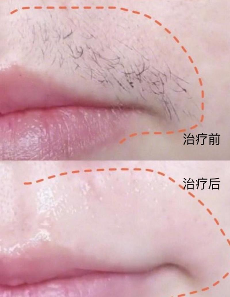 为什么脸会长毛