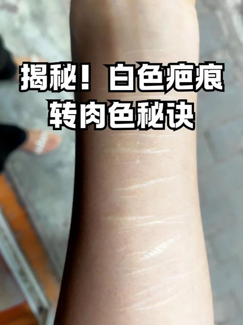 疤痕是什么颜色的