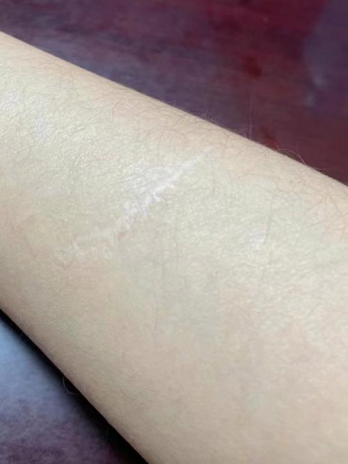 疤痕是什么颜色的