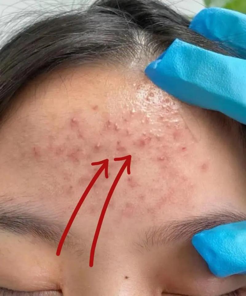 额头长痘能用洗面奶吗