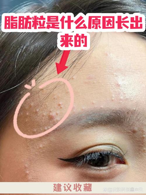 脂肪粒是什么样的