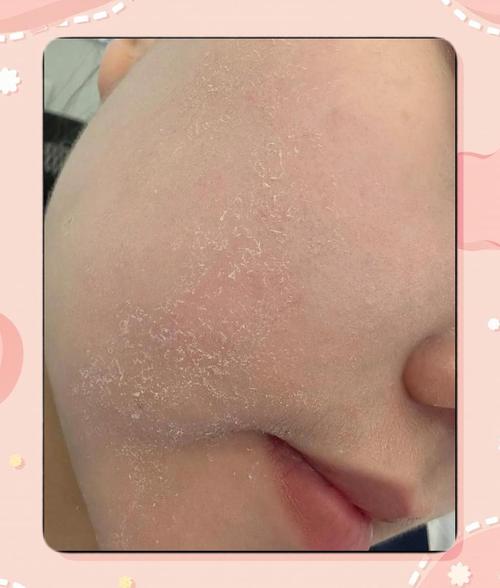 脸上起皮能用洗面奶吗