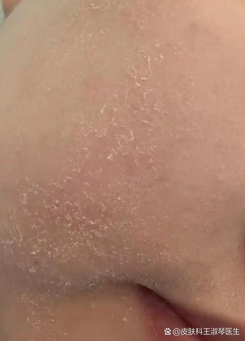 脸上起皮能用洗面奶吗