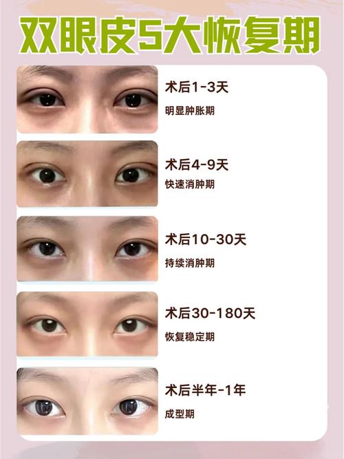 为什么要做双眼皮