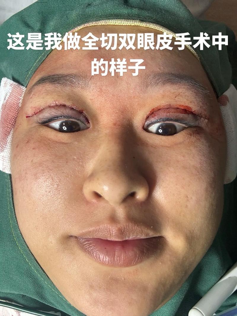 为什么要做双眼皮