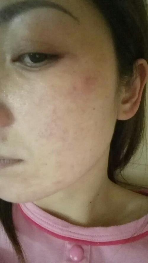 擦过护肤品后有点刺痛