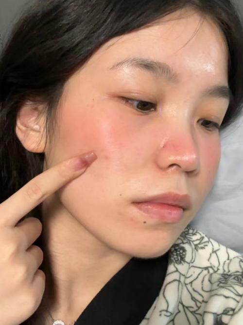 擦过护肤品后有点刺痛