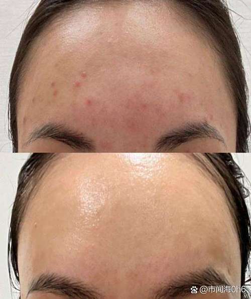 长痘痘还要用洗面奶吗