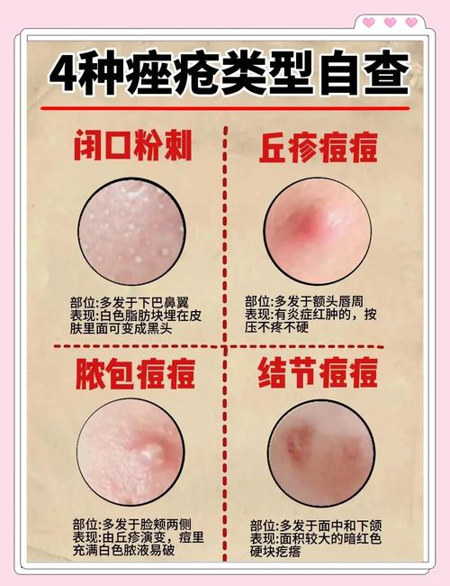 嘴角长痘痘什么原因