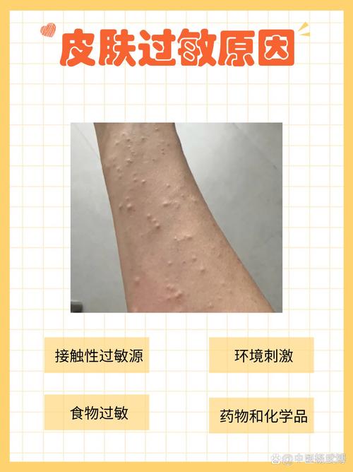 为什么皮肤容易过敏
