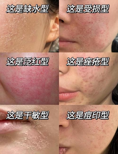 为什么皮肤容易过敏