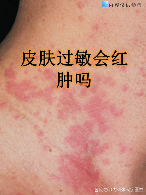 为什么皮肤容易过敏