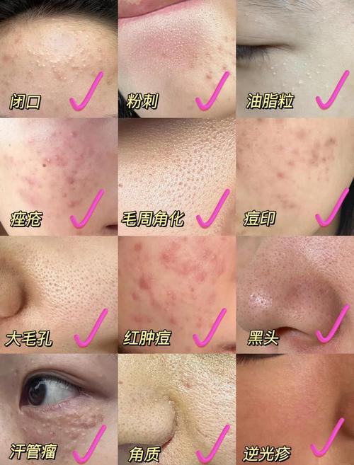 什么护肤品会导致闭口