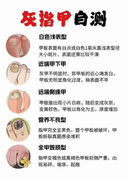 为什么长灰指甲