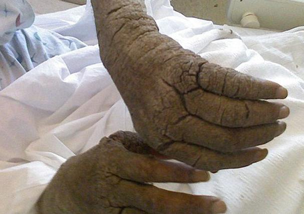 疥疮是什么样的