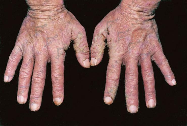 疥疮是什么样的