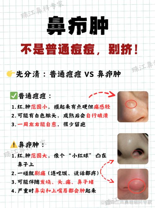 鼻子上为什么长痘