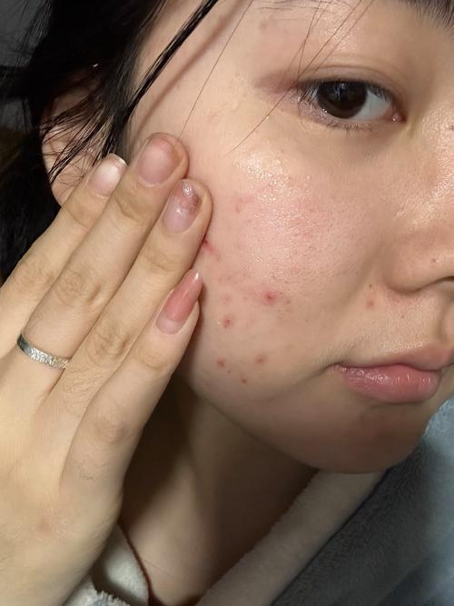 肤美灵洗面奶用了过敏