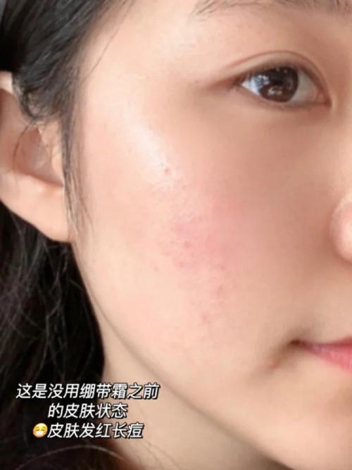 肤美灵洗面奶用了过敏