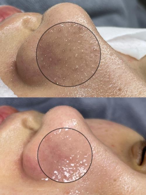 什么护肤品可以去黑头