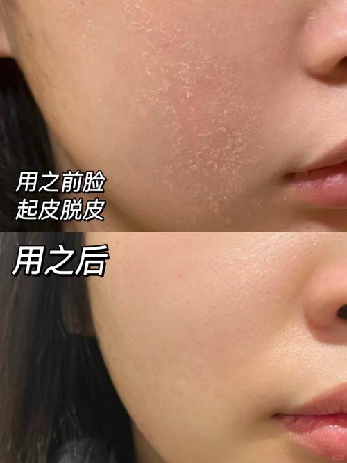 脸干燥脱皮护肤品最好