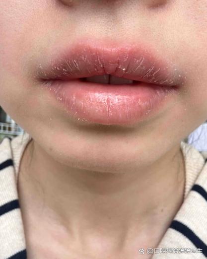 嘴唇脱皮缺什么