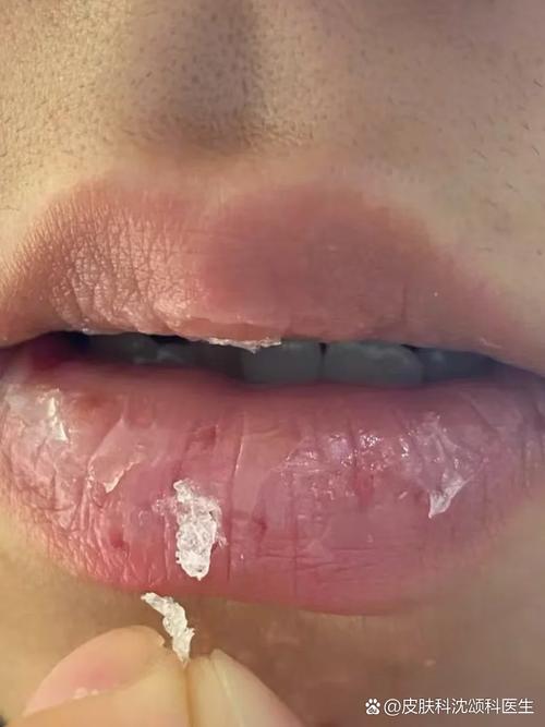 嘴唇脱皮缺什么