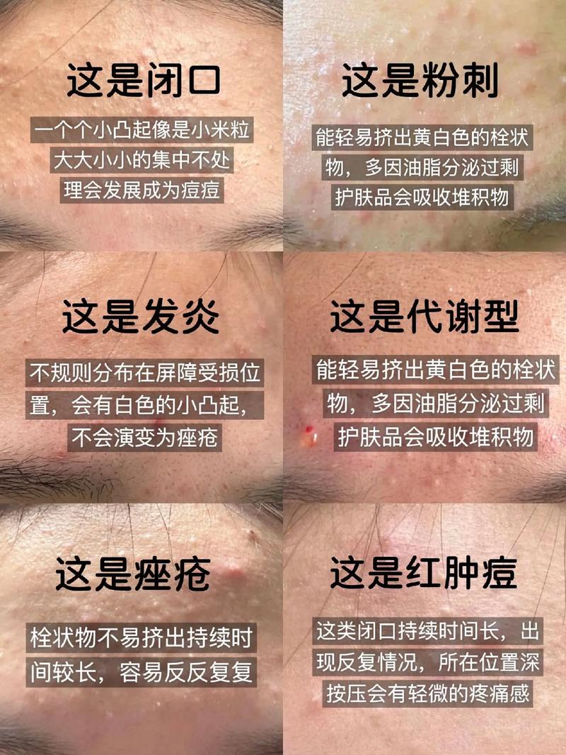 长粉刺不用护肤品好了