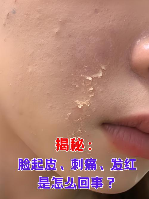 洗面奶洗脸后脸部刺痛