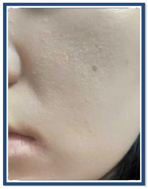 洗面奶洗脸后脸部刺痛