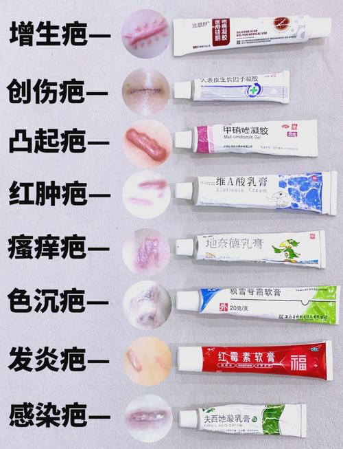 疤痕增生用什么药膏
