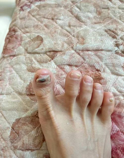 灰指甲什么颜色