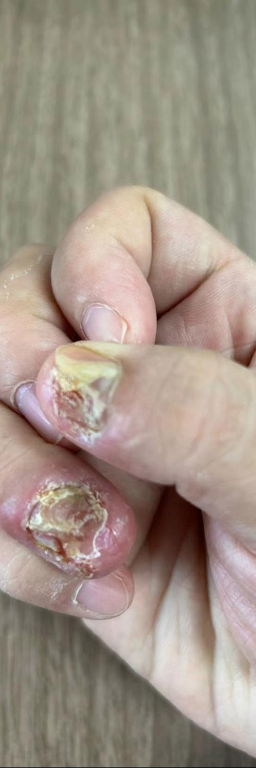 灰指甲什么颜色